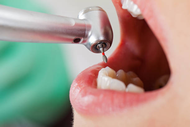 Best Emergency Dental Extractions in Bar Nunn, WY